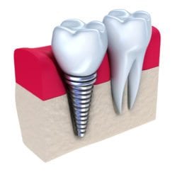 dental implants albany ny