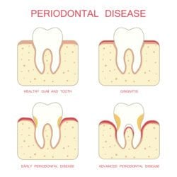 periodontal therapy cohoes ny