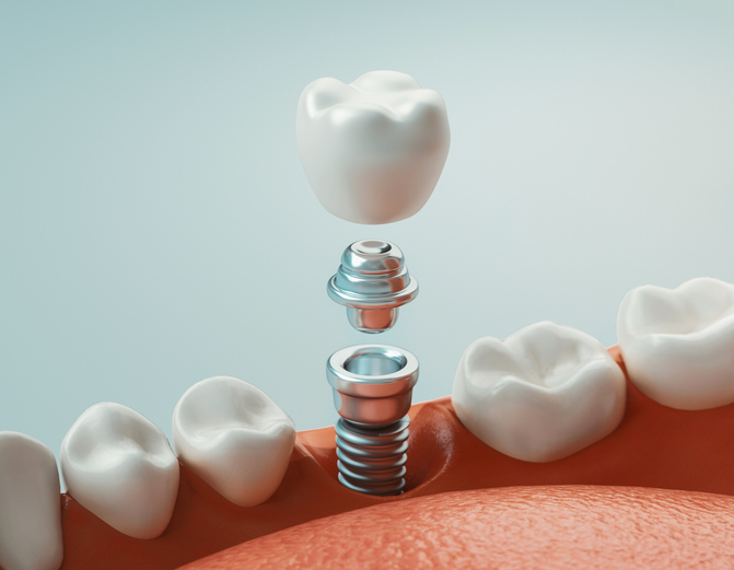Dental Implants Cohoes, NY