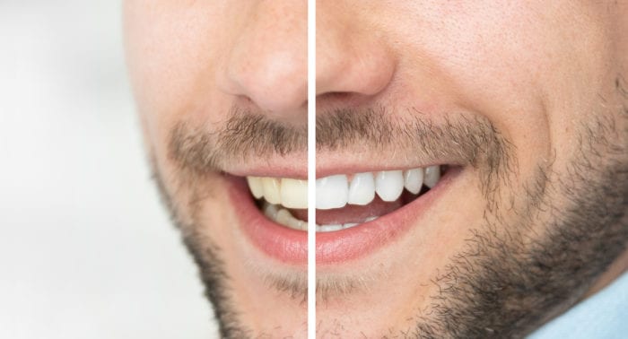 Treat Yellow Teeth in Cohoes, New York