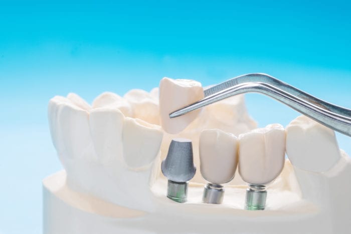 Dental Implant Questions in Cohoes, New York