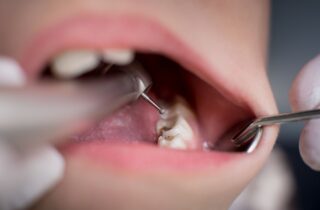 Open mouth during drilling treatment at the dentist in dental clinic dental filling cavities general dentistry dentist in Cohoes New York