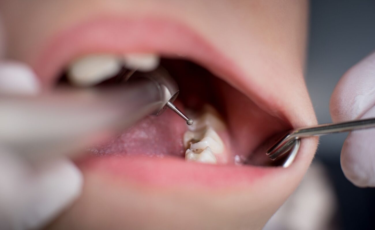 The Process of a Dental Filling - Dentist in Cohoes, NY
