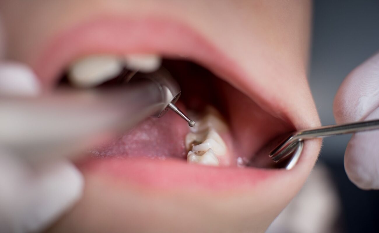 How can I temporarily fill a hole in my tooth? - Find A Dentist, DentalVibe