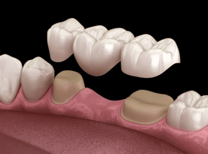 3D render of traditional dental bridge restorative dentistry dentist in Cohoes New York