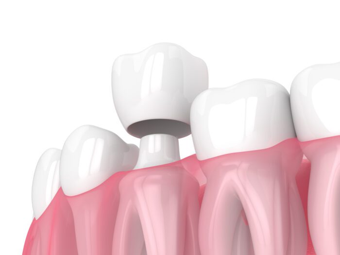 A Dental Crown in Cohoes, NY can help restore your smile and protect your teeth