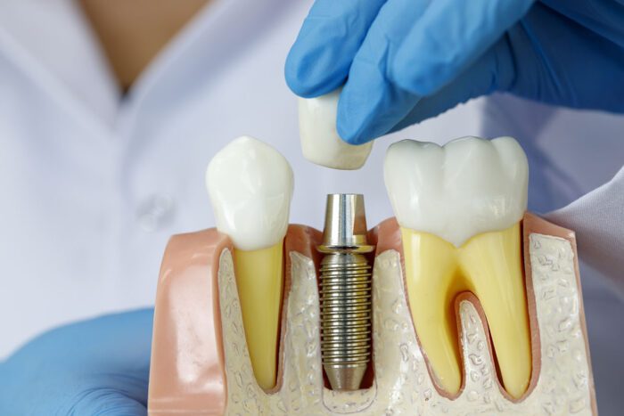 MISSING TEETH in Cohoes, NY, can be treated with a variety of options