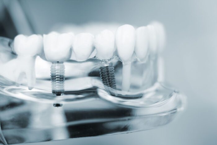 Dental implants can benefit patients with missing teeth. However, they may not be the right treatment for everyone.