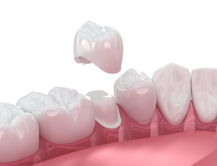 Understanding the process of getting a dental crown can alleviate some of the anxiety associated with your appointment.