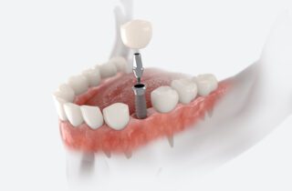 Preparing for dental implant treatment ahead of time can help ensure your aftercare and recovery are smooth and quick.